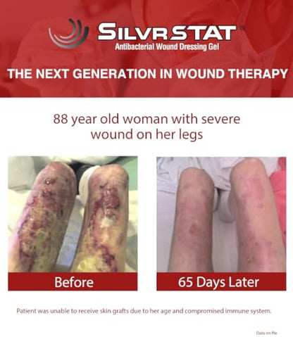 SilvrSTAT First Aid Kit Gel, 32 PPM Silver Healing Wound Dressing Solution, SilverSol Ag₄O₄ Particles, 3 oz - size: 3 Ounce